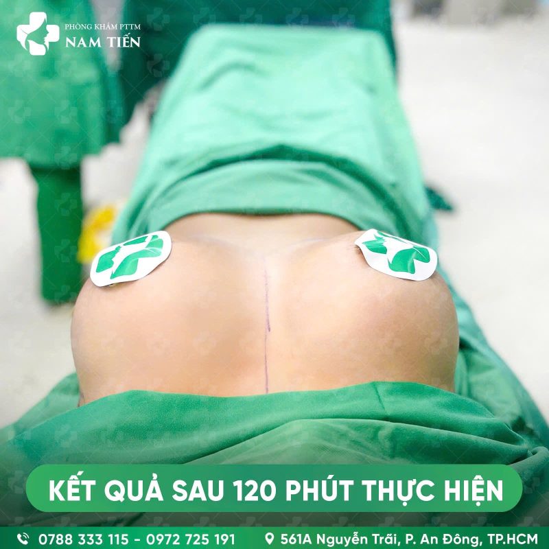 treo sa trễ ngực đường quầng và đặt túi ngực - hình ảnh sau phẫu thuật góc đứng
