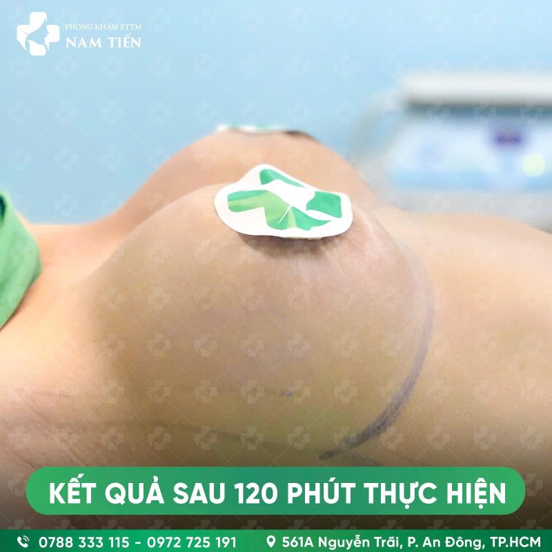 treo sa trễ ngực đường quầng và đặt túi ngực - hình ảnh sau phẫu thuật góc ngang - phòng khám thẩm mỹ Nam Tiến