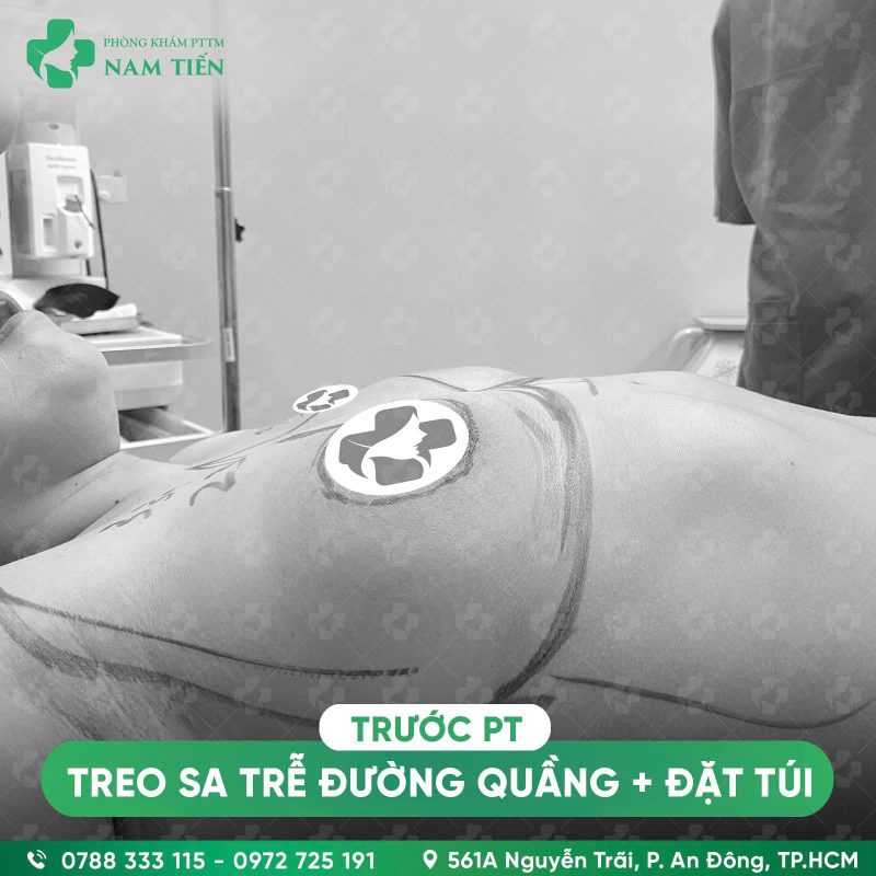 treo sa trễ ngực đường quầng và đặt túi ngực - hình ảnh trước phẫu thuật góc ngang - bác sĩ nguyễn đức tiến tphcm
