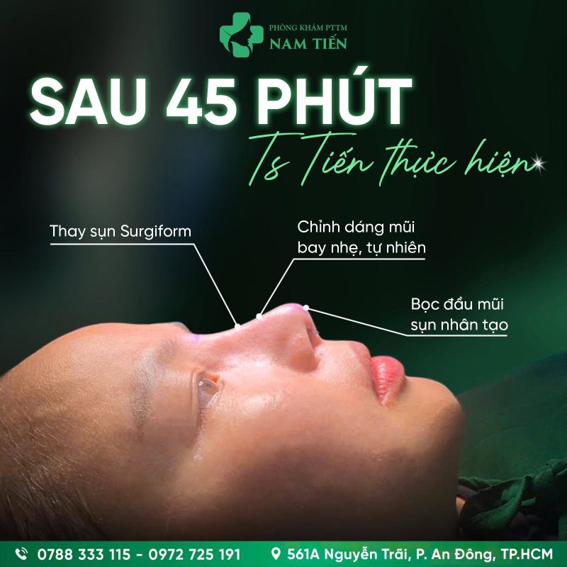 Sau khi nâng mũi