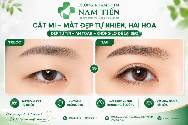 Cắt mí đẹp tphcm-Đẹp Tự Nhiên Chỉ Sau 1 Lần Thực Hiện 2 kết quả sau khi cắt mí tại tphcm