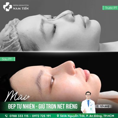 nâng mũi cùng TS,BS.Nguyễn Đức Tiến tại phòng khám PTTMM Nam Tiến