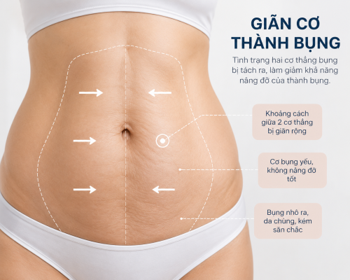 Giãn cơ bụng là gì?