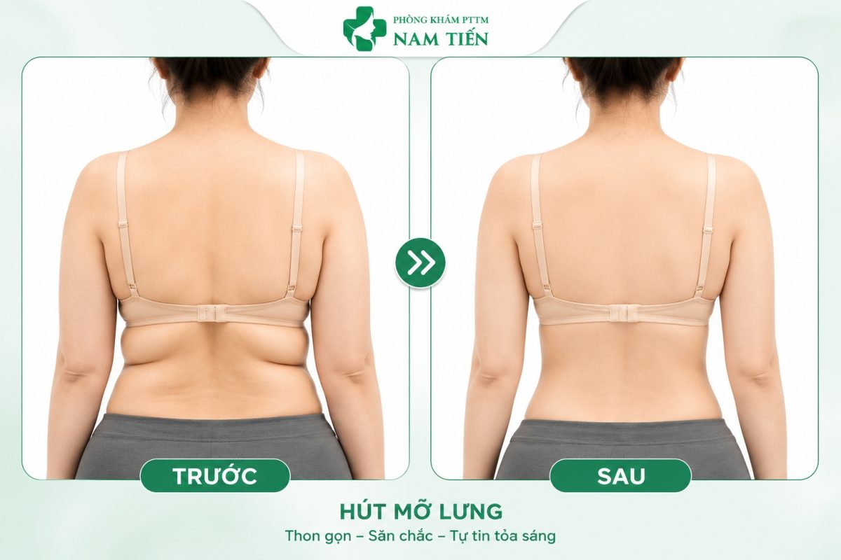 Hình ảnh so sánh trước sau hút mỡ lưng an toàn, cải thiện vóc dáng hiệu quả.