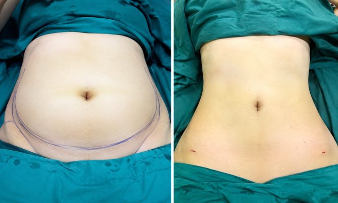 Hút mỡ bụng dưới TPHCM 2 Hút mỡ bụng dưới an toàn TPHCM với kết quả trước và sau tại Phòng khám Nam Tiến