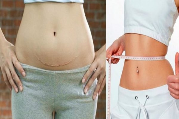 Hút mỡ bụng sau sinh TPHCM: 3 thời điểm thực hiện phù hợp 3 Lợi ích hút mỡ bụng sau sinh TPHCM