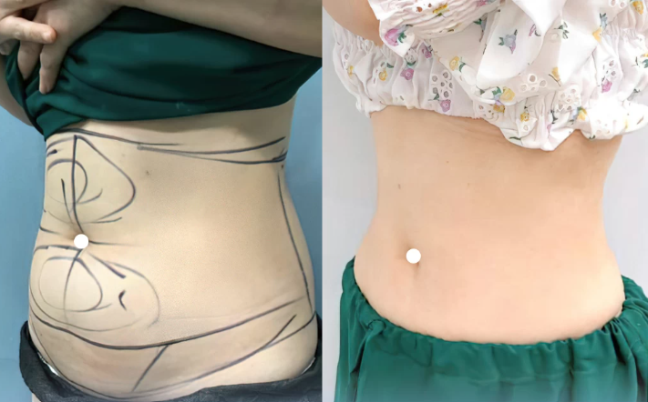 dịch vụ hút mỡ 360 độ TPHCM giúp cải thiện vòng eo, bụng, hông và lưng tại Nam Tiến.