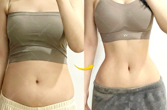 Căng da bụng TPHCM giúp loại bỏ da thừa và tạo vòng eo săn chắc