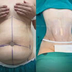 Tạo hình body TPHCM 2 Dịch vụ tạo hình body TPHCM giúp kiến tạo vóc dáng cân đối tự nhiên