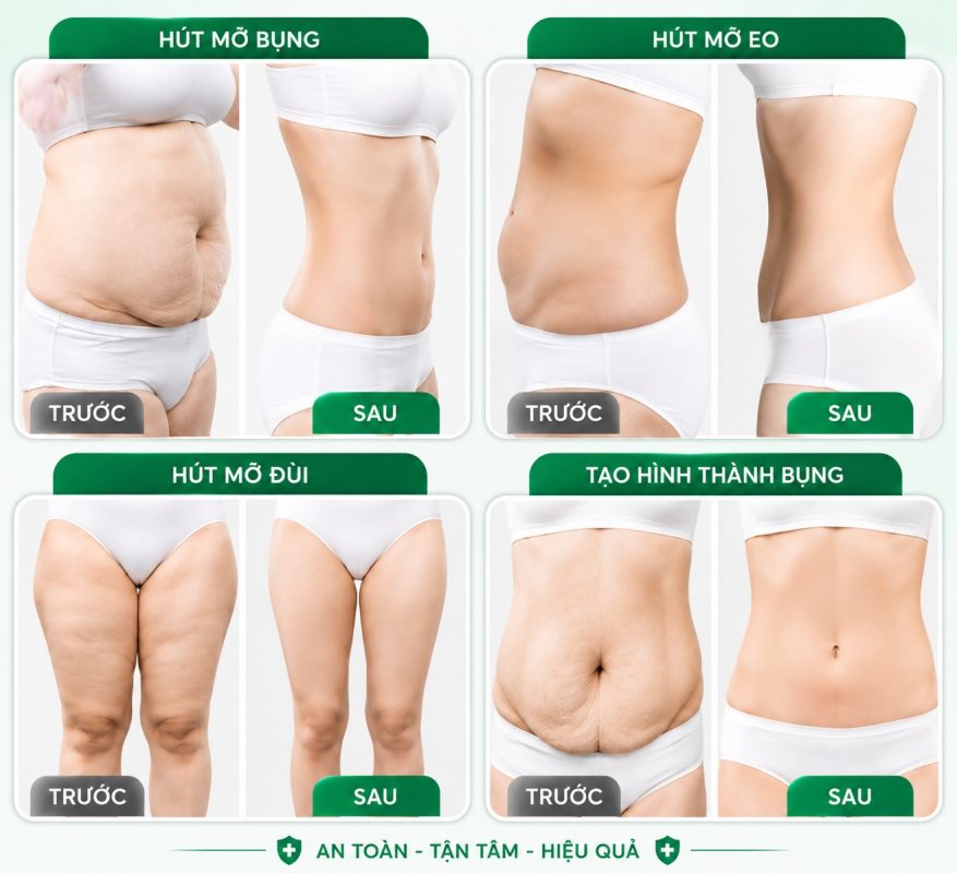 phẫu thuật tạo hình vóc dáng tphcm 2 Hình ảnh trước và sau phẫu thuật tạo hình vóc dáng, hút mỡ bụng, eo và đùi tại TPHCM.